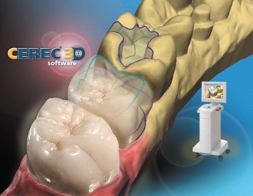 The CEREC CAM