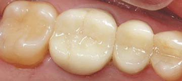 Composite Fillings - After