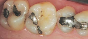 Composite Fillings - Before
