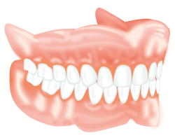 Overdenture Dental Implants