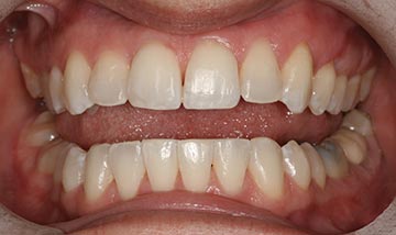 Straight teeth after Six Month Smiles braces correction