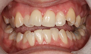 Crooked teeth before Six Month Smiles braces correction