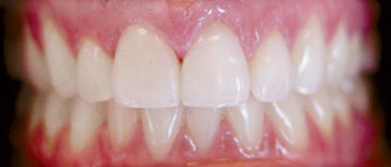 Teeth after porcelain veneers