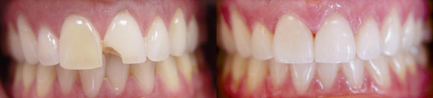 Porcelain Veneers - Before and After