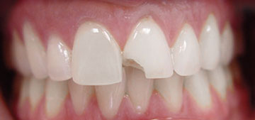 Teeth with chipped front tooth