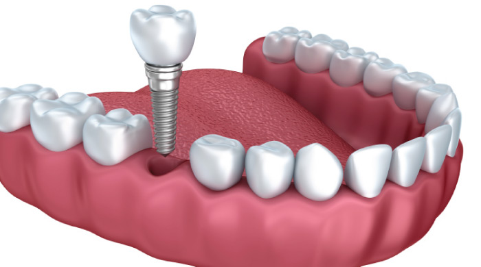 demonstration model of dental implants procedure