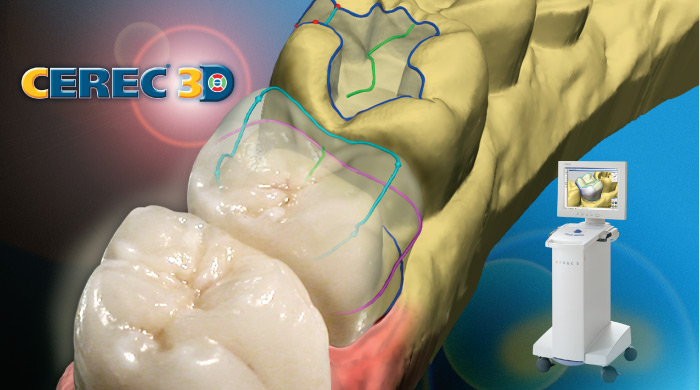 CEREC crowns provide one day service