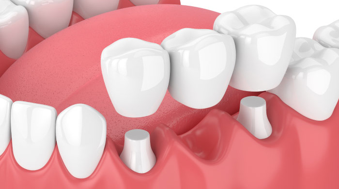 model of the dental bridge procedure