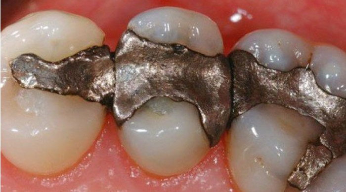 Are Metal Tooth Fillings Dangerous to Health?