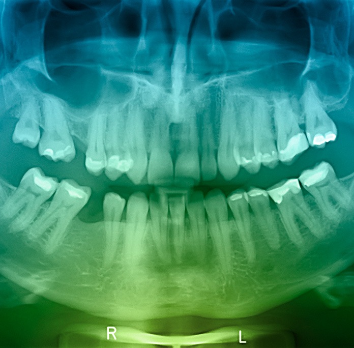 full mouth xray