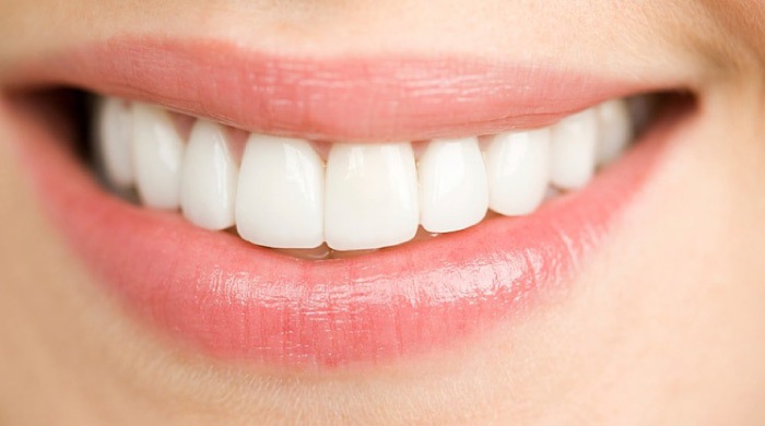 close up of a woman's mouth with porcelain veneers