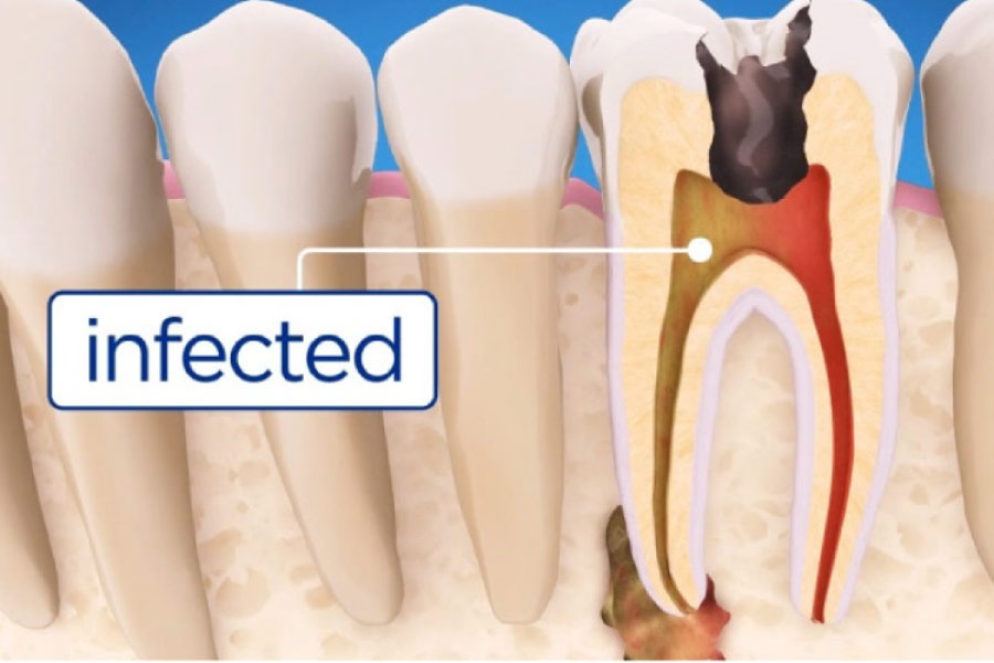 illustration of root canal therapy