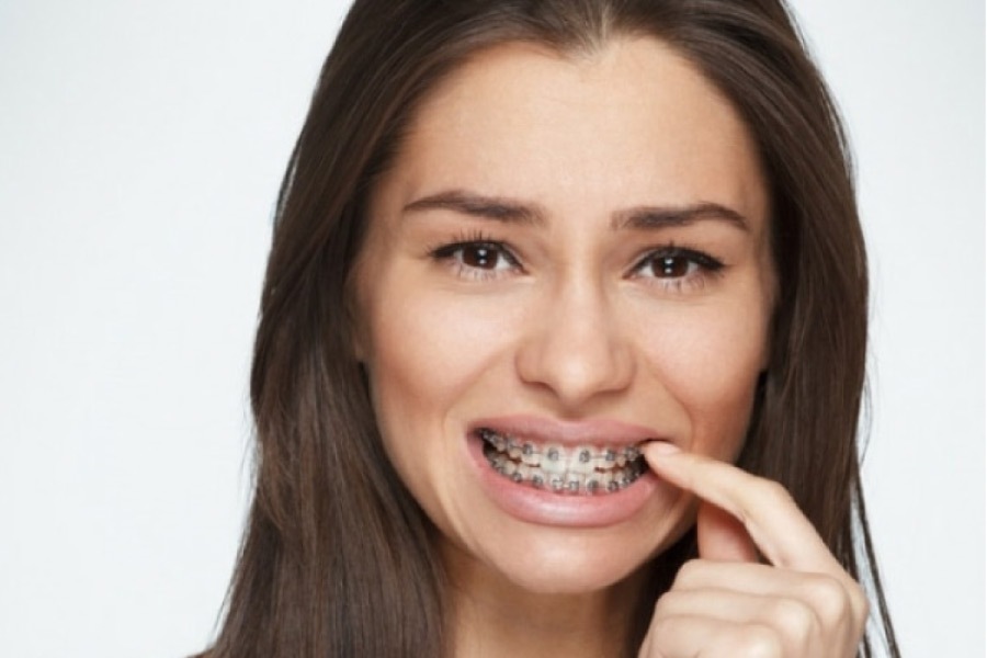 young woman with braces points at a spot of discomfort in her mouth