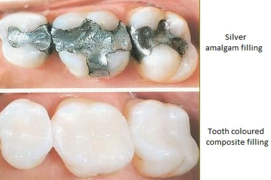 cavity filling comparison