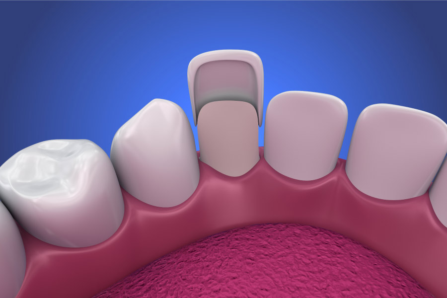 model of dental veneers