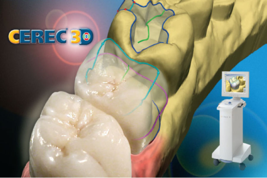 cerec one visit dental crown